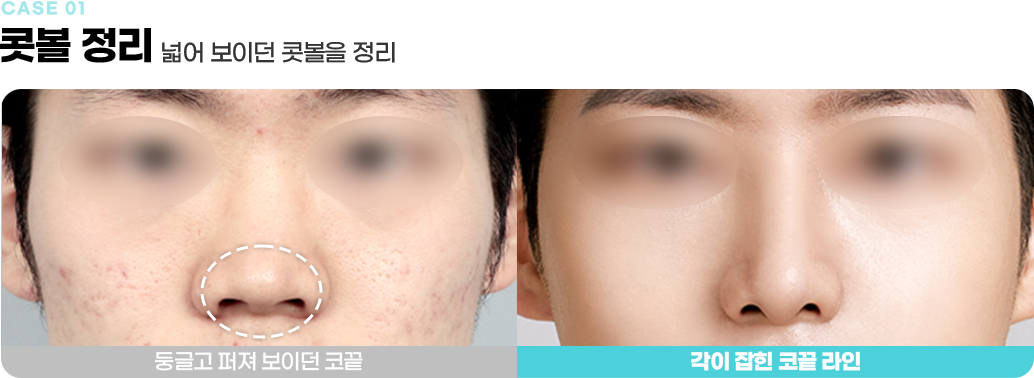 콧볼 정리 수술전후사진