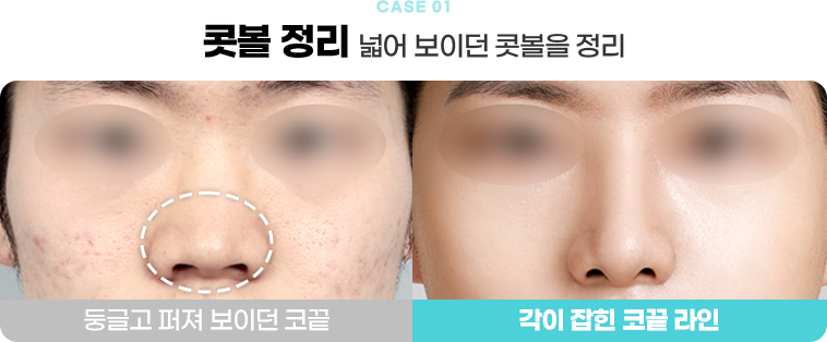 콧볼 정리 수술전후사진