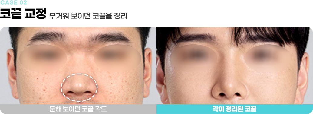코끝 교정 수술전후사진
