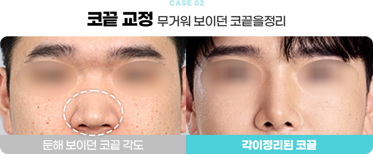 콧끝 교정 수술전후사진