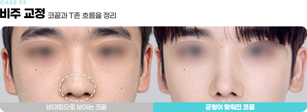비주 교정 수술전후사진