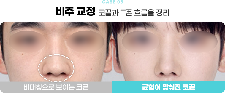 비주 교정 수술전후사진