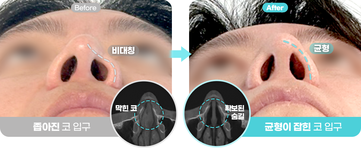 Before&After이미지