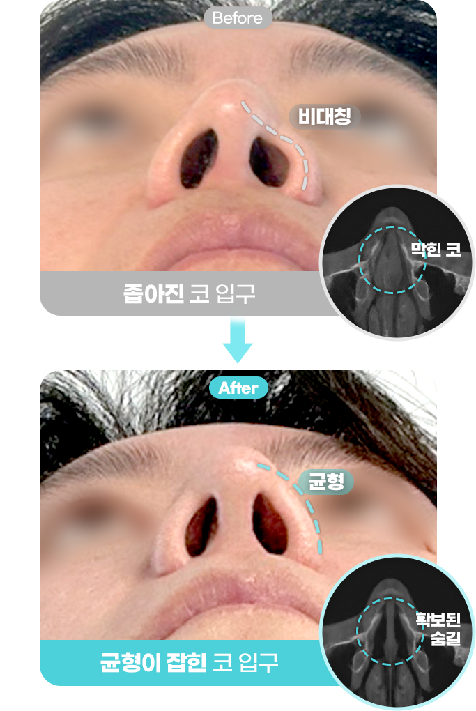 Before&After이미지