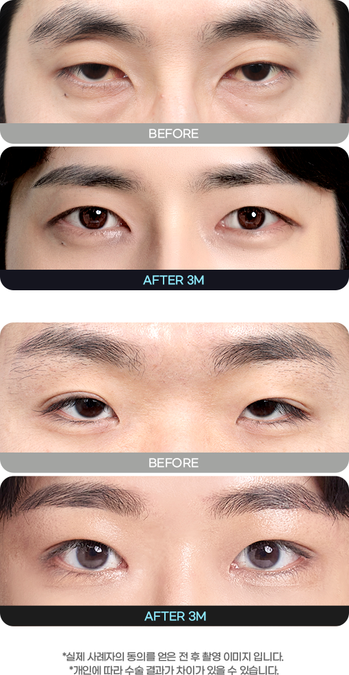 DA 남자성형