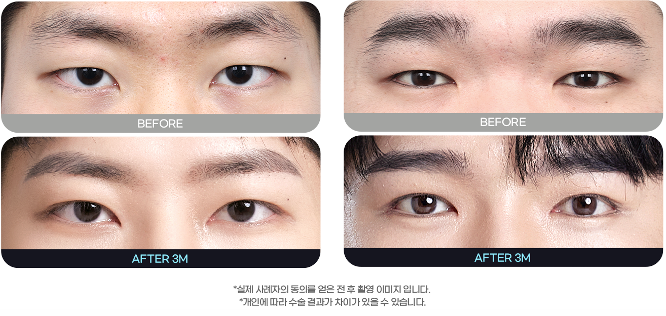DA 남자성형