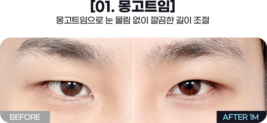 DA 남자성형