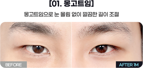 DA 남자성형