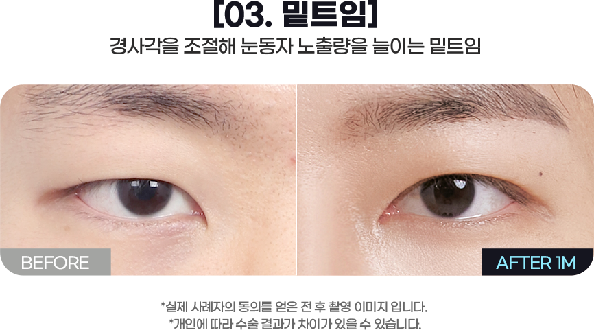 DA 남자성형