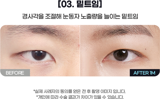 DA 남자성형