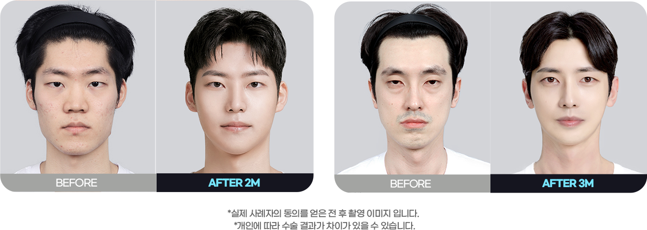 DA 남자성형