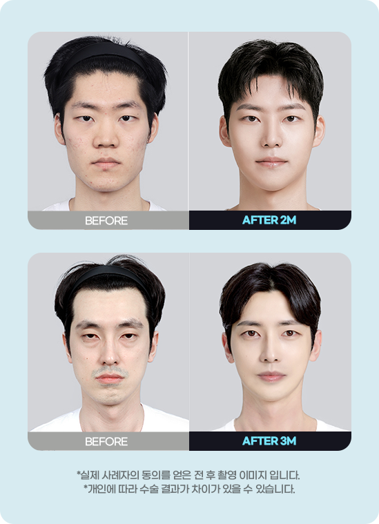 DA 남자성형