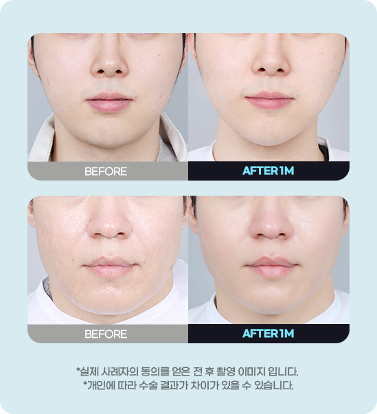 DA 남자성형