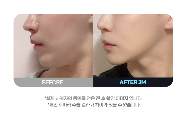 DA 남자성형
