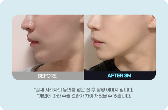 DA 남자성형