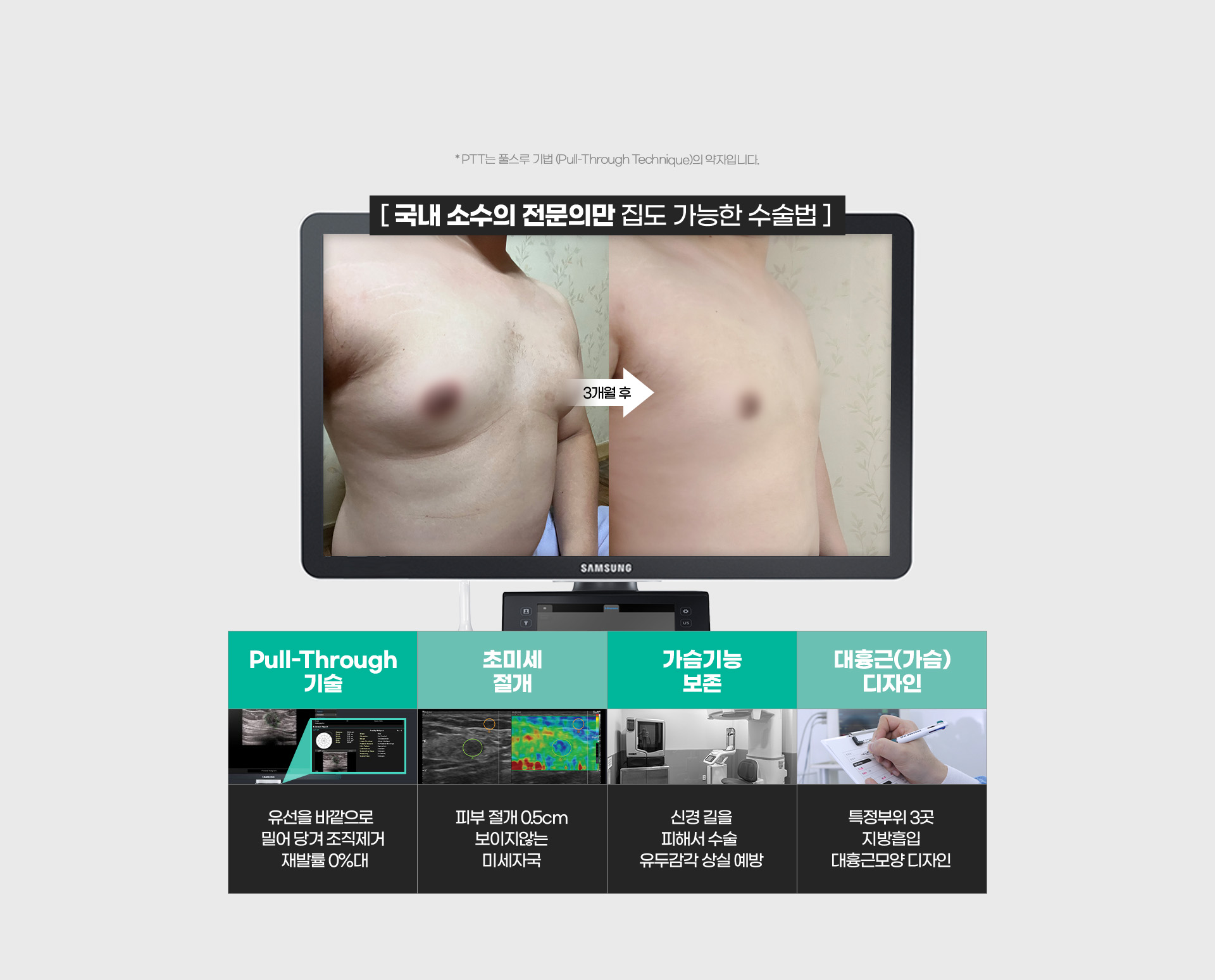 여유증 P.T.T 수술법 도입