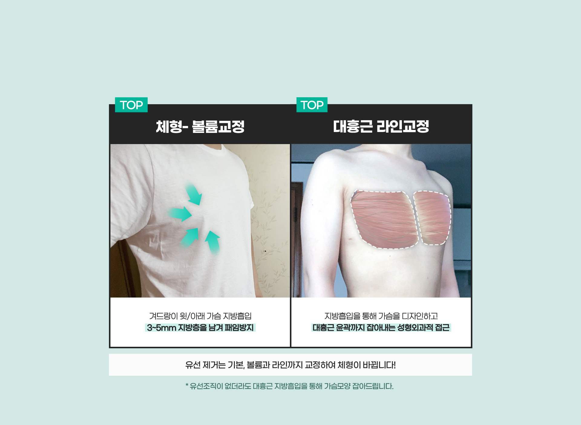 남성 체형, 유선조직, 지방 모두를 고려 재수술 단 1건도 없습니다!