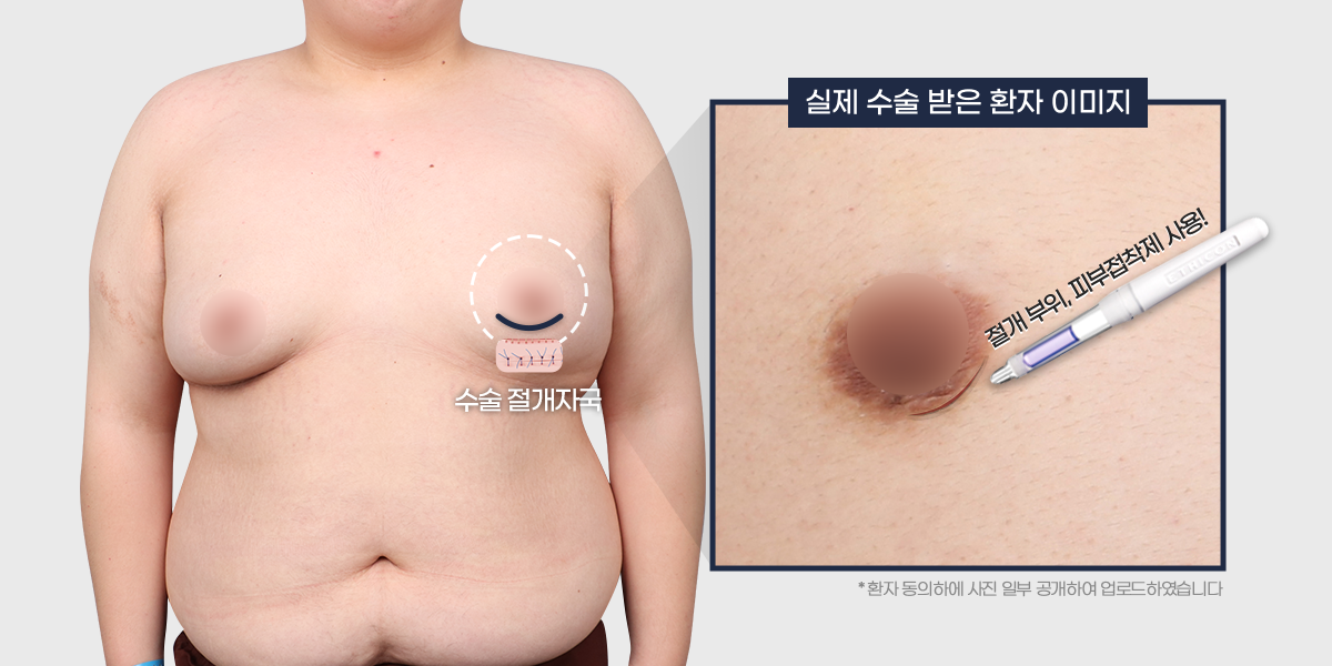 수술 봉합 자국 없음 PC