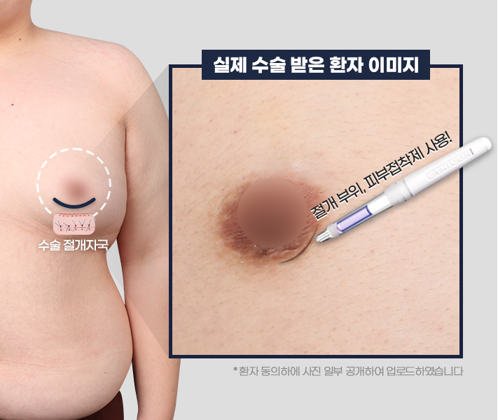 수술 봉합 자국 없음 모바일
