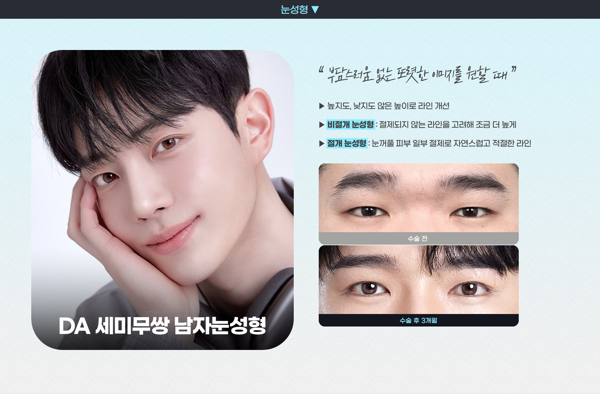 DA 세미무쌍 남자눈성형