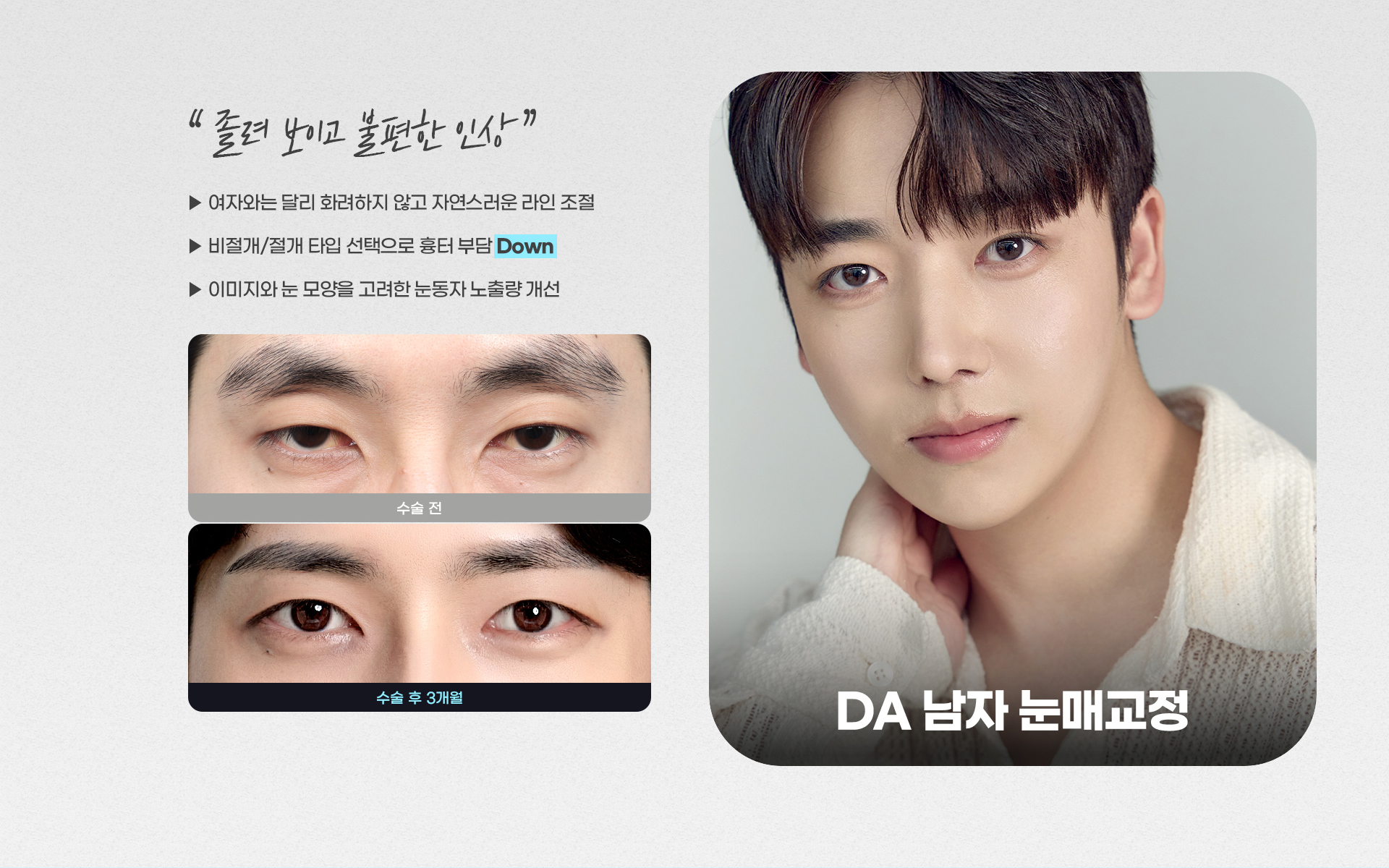 DA 남자 눈매교정