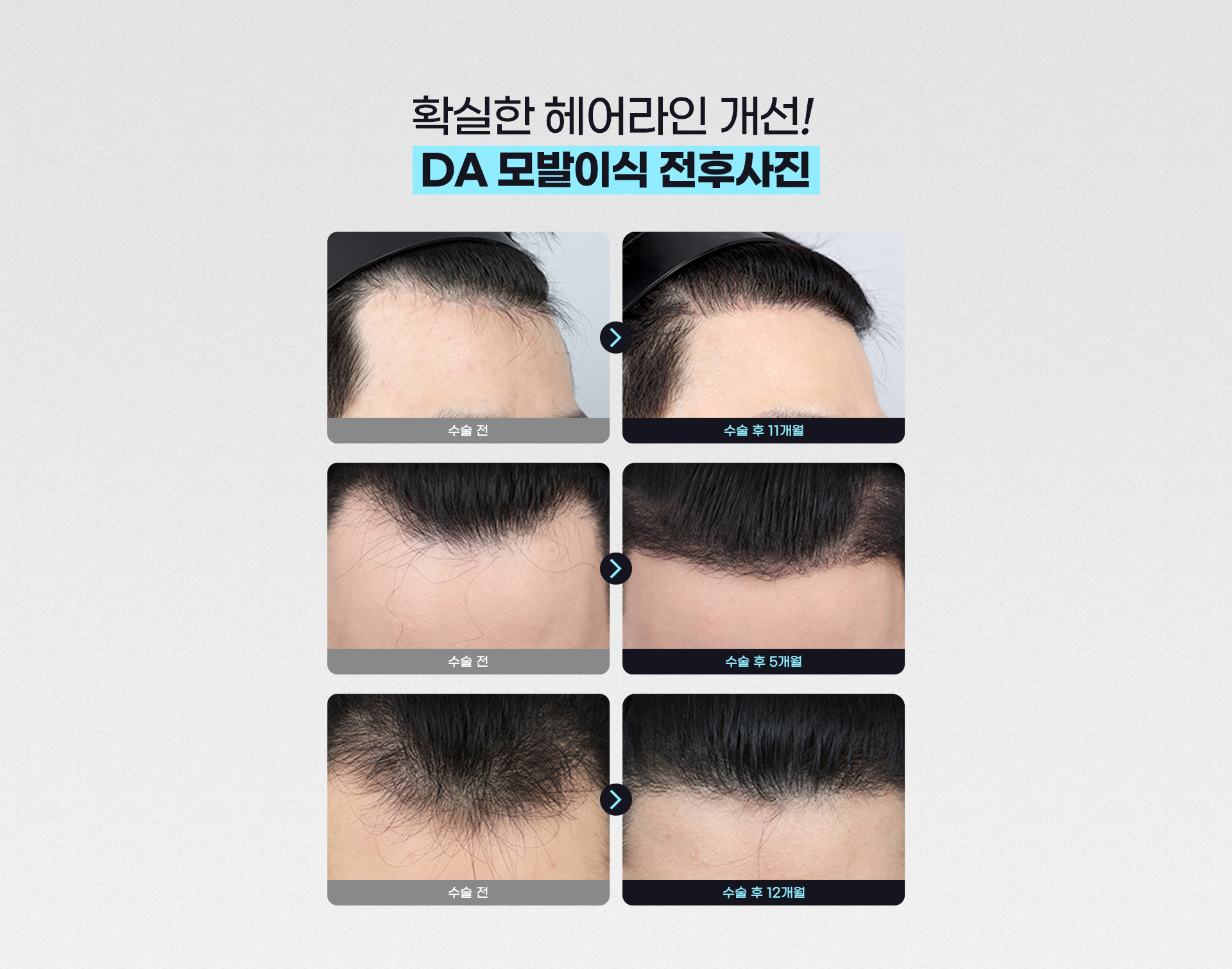 확실한 헤어라인 개선! DA 모발이식 전후사진
