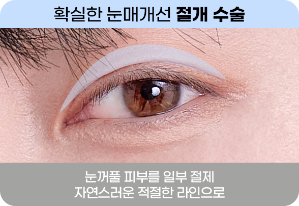 DA 남자 눈성형