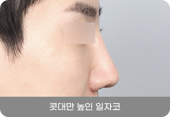 디에이 남자 코성형