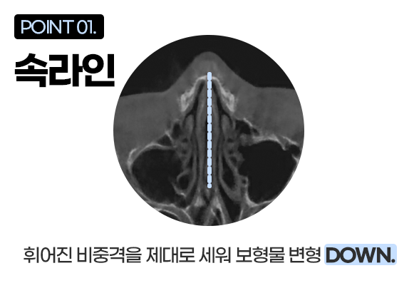 디에이 비염미용코성형