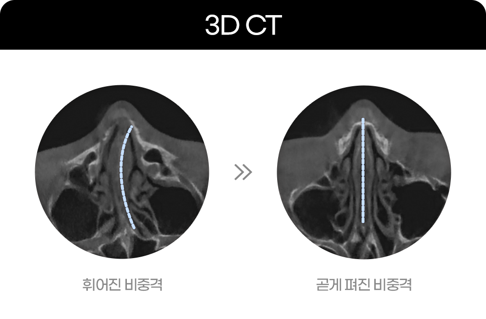 디에이 비염미용코성형