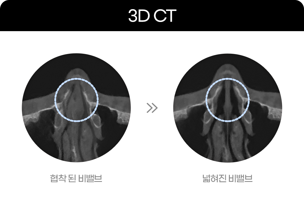 디에이 비염미용코성형