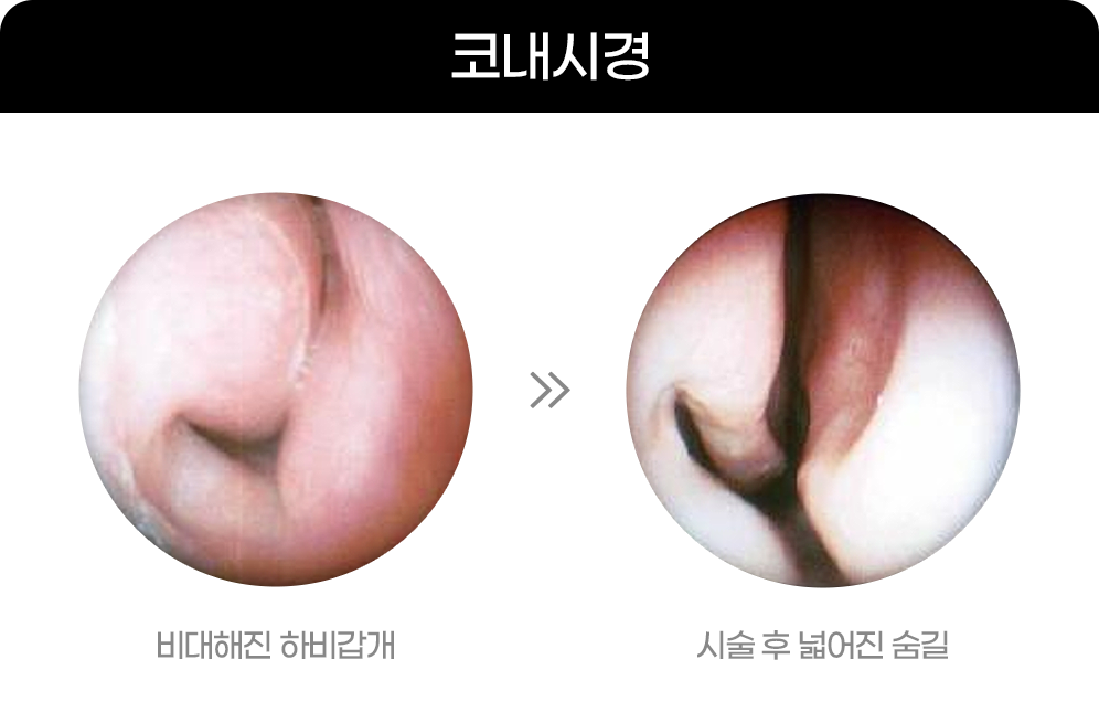 디에이 비염미용코성형