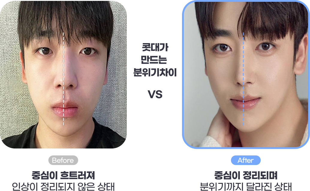 코성형 Before사진