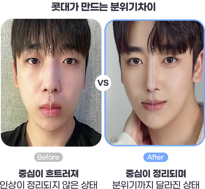 코성형 After사진