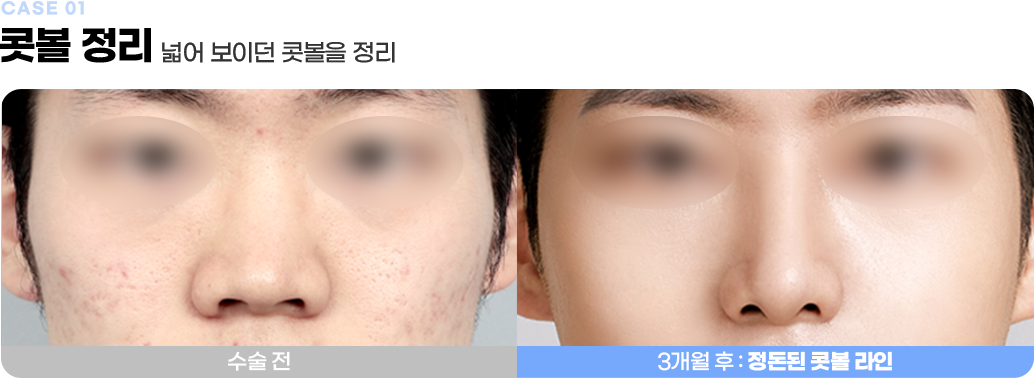 콧볼 정리 수술전후사진