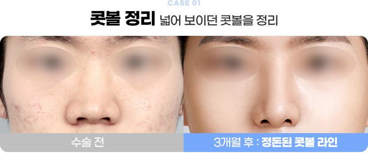 콧볼 정리 수술전후사진