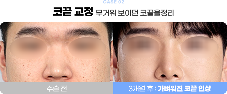 콧끝 교정 수술전후사진