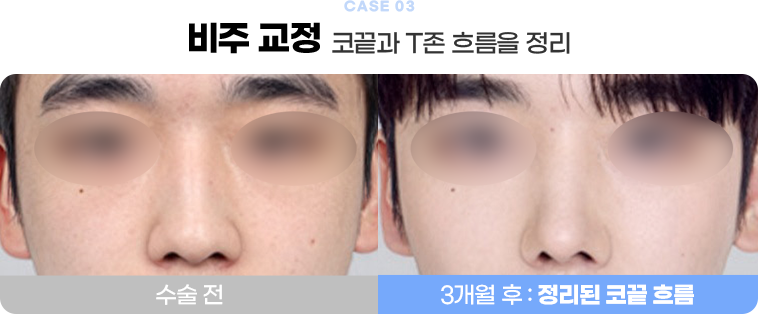 비주 교정 수술전후사진