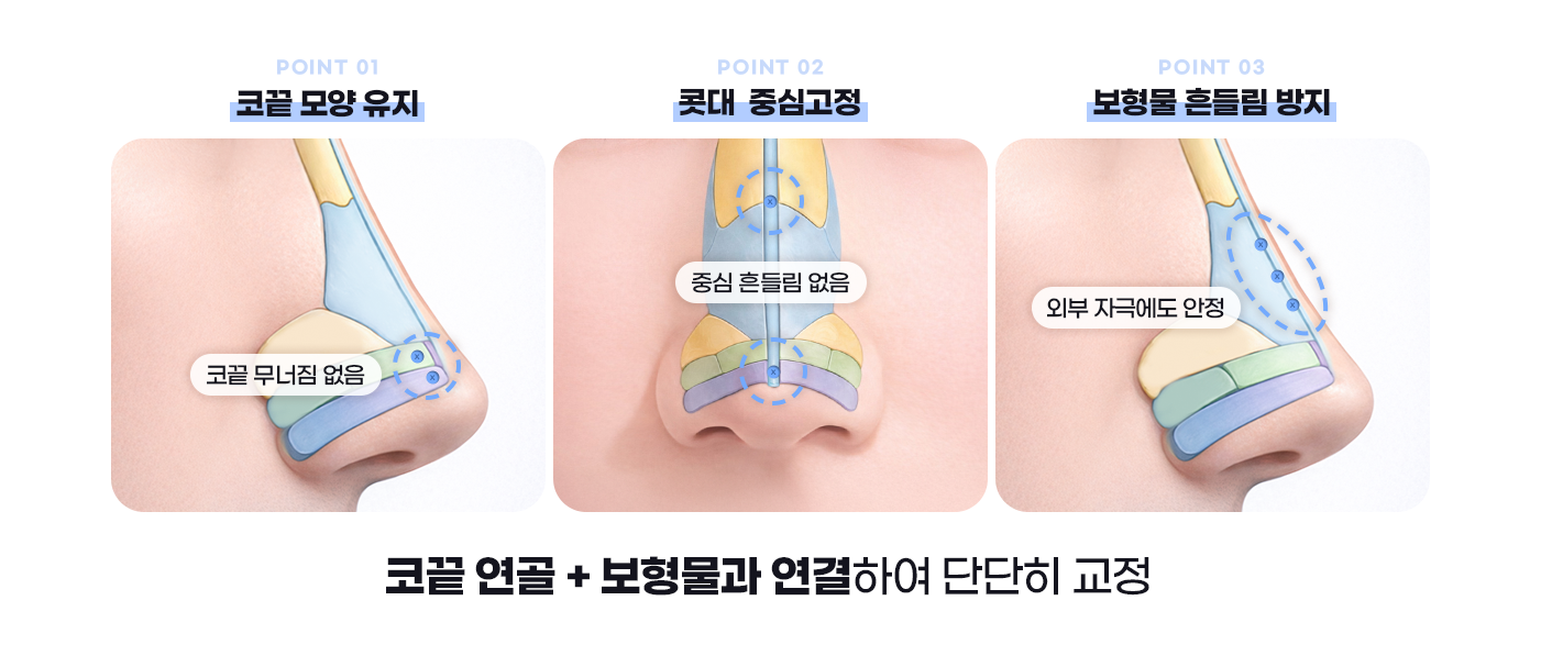 코끝모양, 콧대 중심고정, 보형물 흔들림 방지