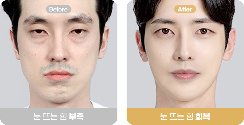 눈 뜨는 힘 부족