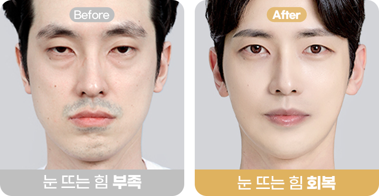 눈 뜨는 힘 회복