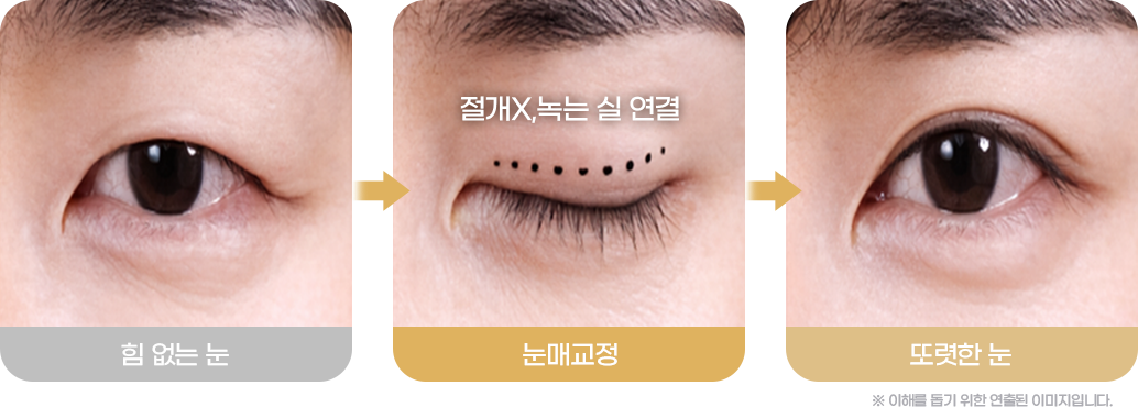 눈매교정 Before&After사진