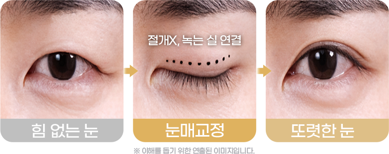 눈매교정 Before&After사진