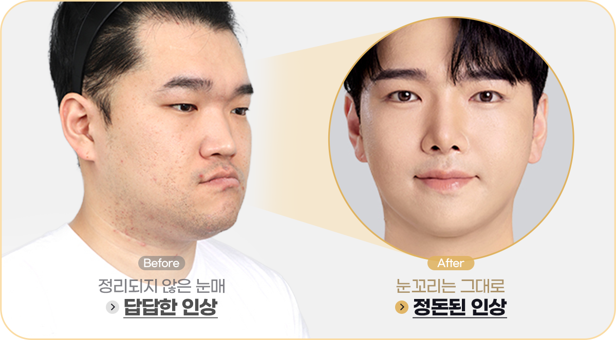 눈매교정 Before&After사진