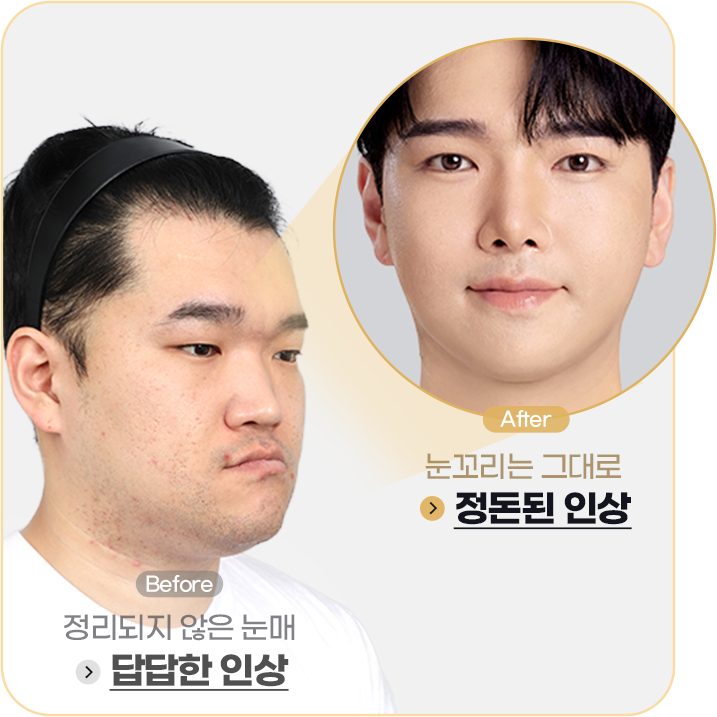 눈매교정 Before&After사진