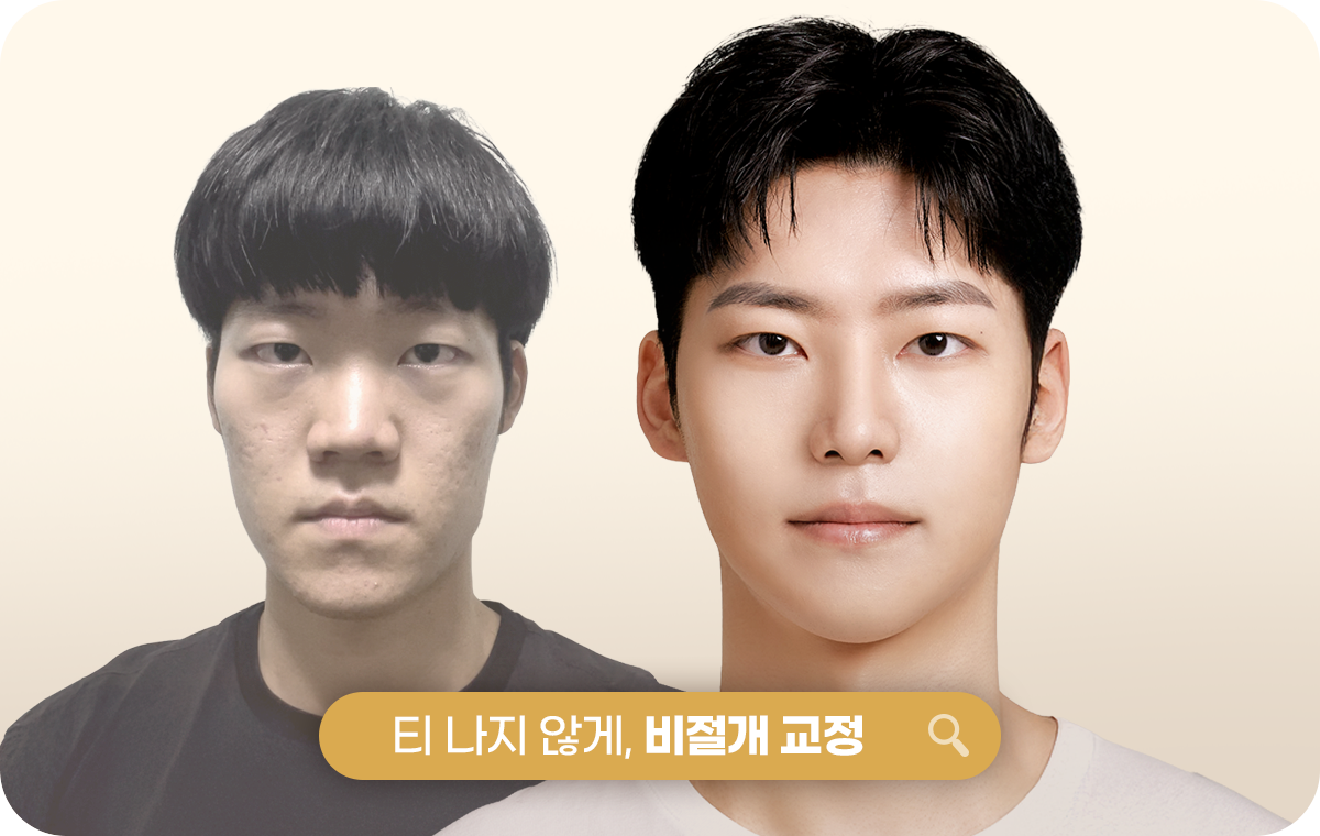 티나지 않게, 비절개 교정