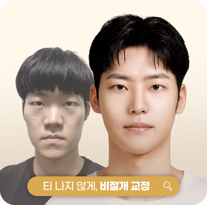 티나지 않게, 비절개 교정