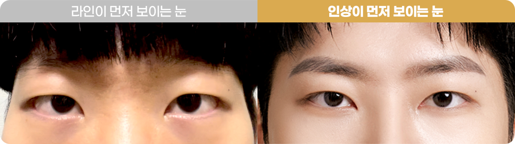 눈매교정 Before&After 사진