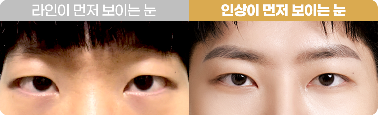 눈매교정 Before&After 사진