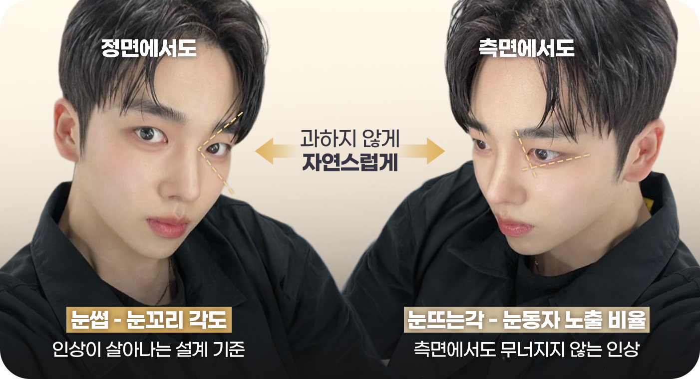 눈매교정 정리된 인상